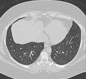 Abb1: CT-Bild einer akuten exogen allergischen Alveolitis