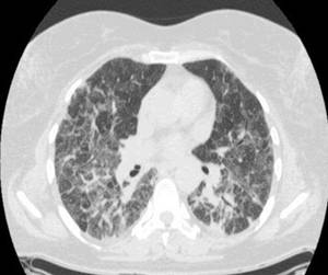 Abb2: CT-Bild einer fortgeschrittenen chronischen Alveolitis   