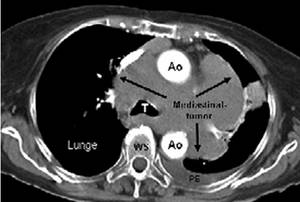 Abb2: Computertomogramm (CT) eines) Patienten mit großem Mediastinaltumor 