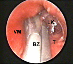 Abb1: Gewebeentnahme durch Mediastinoskopie 