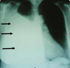 Abb1: Röntgenaufnahme mit Pleuraerguss rechts 
