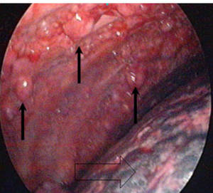 Abb2: Thorakoskopie (Spiegelung des Brustkorbes)