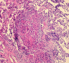 Abb2: epitheloidzelliges Granulom 