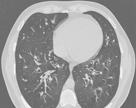 Abb2: Im CT des Thorax Nachweis von Bronchiektasen